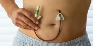 Abordaje Integral del Paciente Ostomizado desde el Rol del Tcae